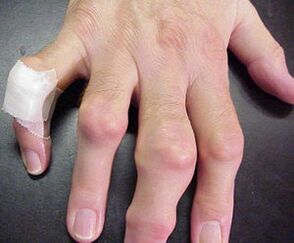 fingers with deformities of the joints cause pain