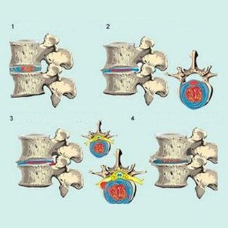 developmental stages of cervical osteochondrosis