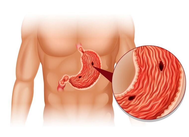 ulcer as a cause of pain under the left back shoulder