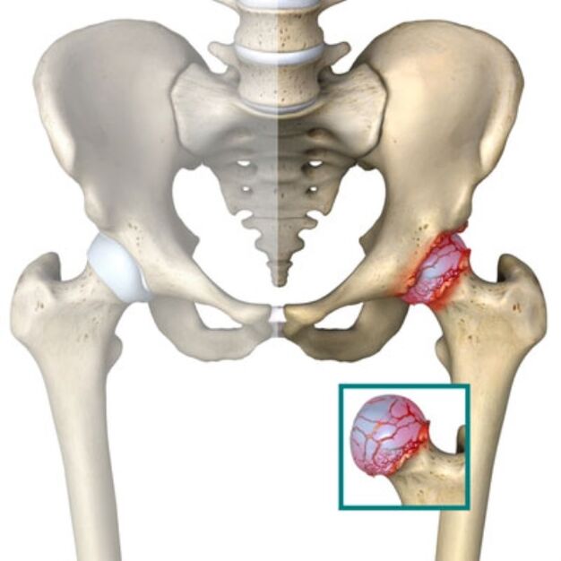 arthritis of the hip joint