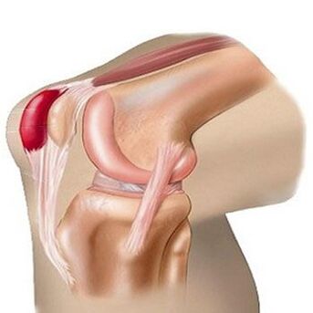 One of the causes of knee joint pain is bursitis. 