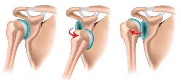 Anterior and posterior dislocation of the shoulder joint, causing joint growth