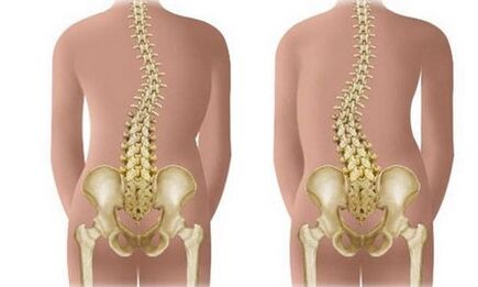 Non -durable scoliosis