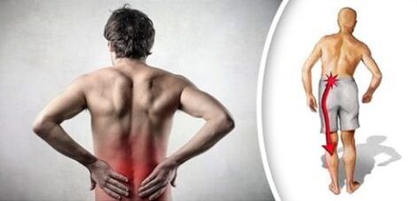 Pain syndrome with lumbar osteochondria radiates on legs