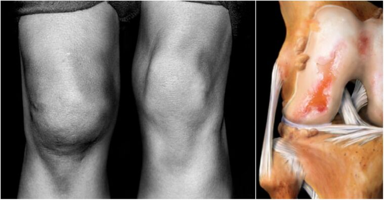 Articulation of the knee joint and painful joint