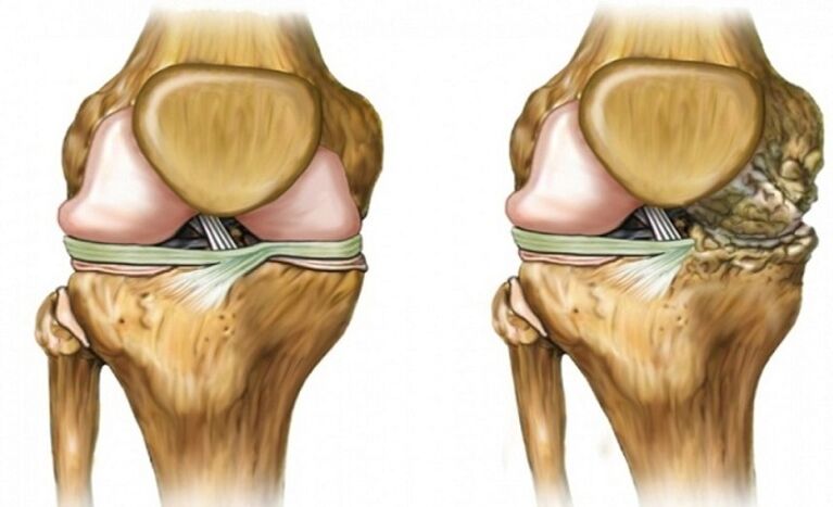 Healthy and affected by the articular joint
