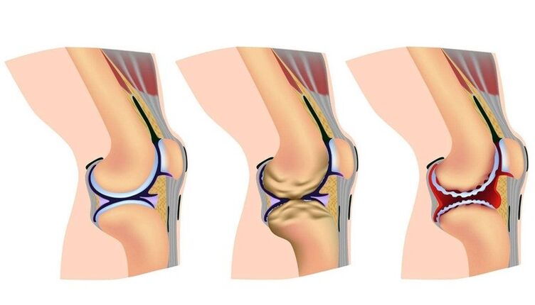 Stages of deformation in the knee joint for arthritis