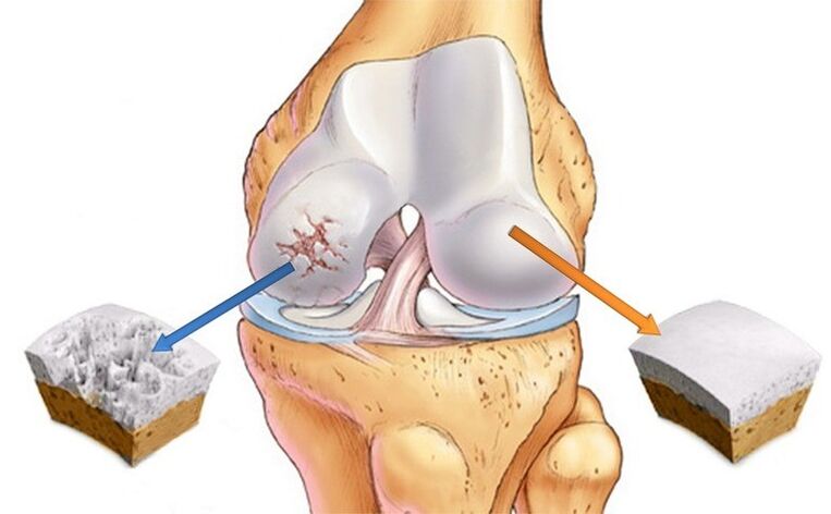 normal cartilage and affected by arthritis