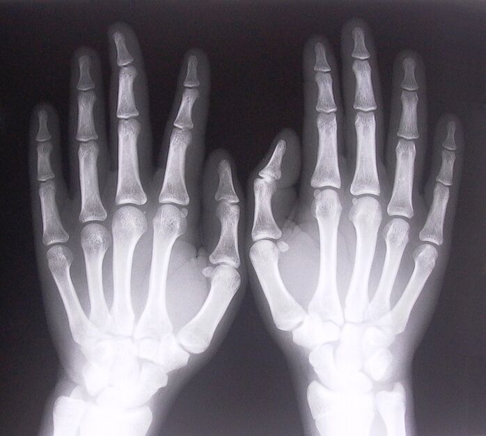 X-ray as a way of diagnosing pain in finger joints