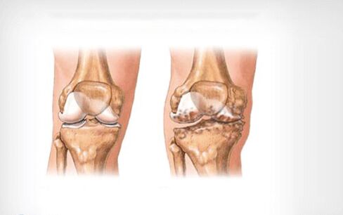 arthropathy of the knee joint
