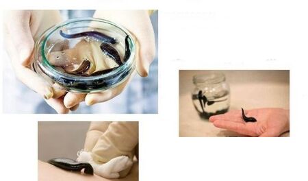 irudotherapy for joints