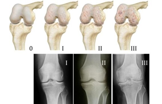methods for the diagnosis of knee arthropathy