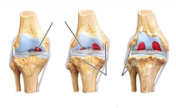 stages of knee arthropathy